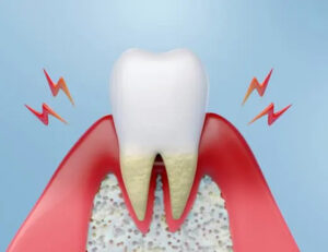 秋葉原の歯医者、スマイルデザインデンタルクリニック秋葉原で、歯の神経を抜いたあとの違和感について解説