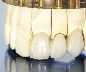 秋葉原の歯医者、スマイルデザインデンタルクリニック秋葉原で、仮歯を放置するリスクについて解説