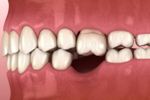 秋葉原の歯医者、スマイルデザインデンタルクリニック秋葉原で、咬合性外傷を解説