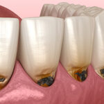 秋葉原の歯医者、スマイルデザインデンタルクリニック秋葉原で、痛みがなかった歯が治療後に痛くなったのはなぜ？原因や対処法を解説