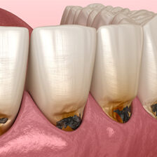 秋葉原の歯医者、スマイルデザインデンタルクリニック秋葉原で、痛みがなかった歯が治療後に痛くなったのはなぜ？原因や対処法を解説