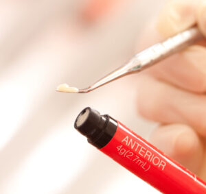 秋葉原の歯医者、スマイルデザインデンタルクリニック秋葉原で、くさび状欠損を解説