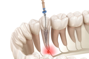 秋葉原の歯医者、スマイルデザインデンタルクリニック秋葉原で、痛みがなかった歯が治療後に痛くなったのはなぜ？原因や対処法を解説