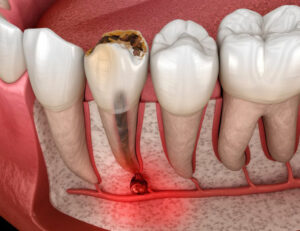 秋葉原の歯医者、スマイルデザインデンタルクリニック秋葉原で、痛みがなかった歯が治療後に痛くなったのはなぜ？原因や対処法を解説