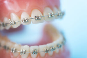 秋葉原の歯医者、スマイルデザインデンタルクリニック秋葉原で、矯正治療で口元が下がる原因や対処法について解説
