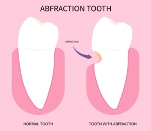 秋葉原の歯医者、スマイルデザインデンタルクリニック秋葉原で、くさび状欠損を解説