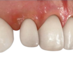 秋葉原の歯医者、スマイルデザインデンタルクリニック秋葉原で矮小歯についての解説