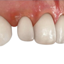 秋葉原の歯医者、スマイルデザインデンタルクリニック秋葉原で矮小歯についての解説