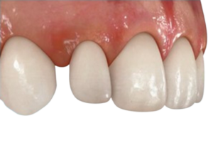 秋葉原の歯医者、スマイルデザインデンタルクリニック秋葉原で矮小歯についての解説