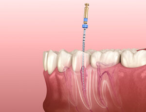 “前歯が欠けたときの応急処置方法と歯科医院での治療方法を解説