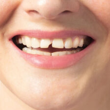 秋葉原の歯医者、スマイルデザインデンタルクリニック秋葉原で、“前歯が欠けたときの応急処置方法と歯科医院での治療方法を解説