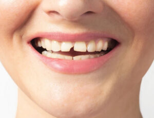 秋葉原の歯医者、スマイルデザインデンタルクリニック秋葉原で、“前歯が欠けたときの応急処置方法と歯科医院での治療方法を解説