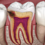 秋葉原の歯医者、スマイルデザインデンタルクリニック秋葉原で、隣接面カリエスについて解説