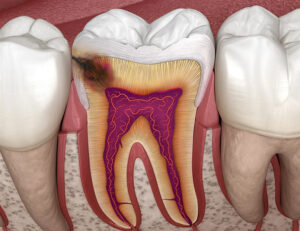 秋葉原の歯医者、スマイルデザインデンタルクリニック秋葉原で、隣接面カリエスについて解説