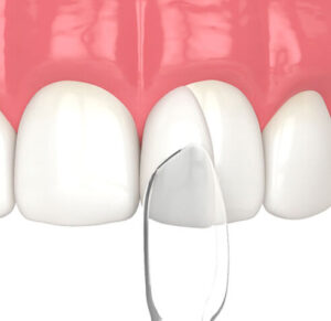 “前歯が欠けたときの応急処置方法と歯科医院での治療方法を解説