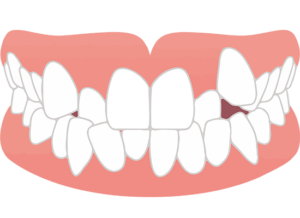 秋葉原の歯医者、スマイルデザインデンタルクリニック秋葉原で、隣接面カリエスについて解説