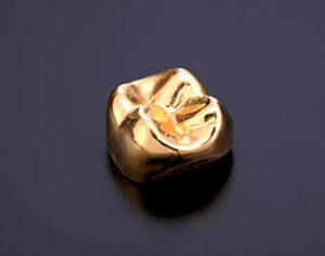 秋葉原の歯医者、スマイルデザインデンタルクリニック秋葉原で、歯の詰め物が取れやすい人の原因と予防策を解説