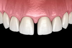 秋葉原の歯医者、スマイルデザインデンタルクリニック秋葉原で、前歯のすき間「正中離開」が大人になって目立つ理由と治療法を解説