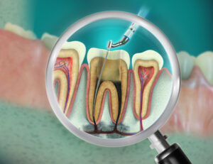 秋葉原の歯医者、スマイルデザインデンタルクリニック秋葉原で、「ボロボロの虫歯」を放置するとどうなる？命に関わるリスクについて解説