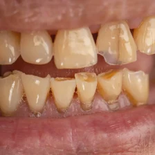 秋葉原の歯医者、スマイルデザインデンタルクリニック秋葉原で、「ボロボロの虫歯」を放置するとどうなる？命に関わるリスクについて解説