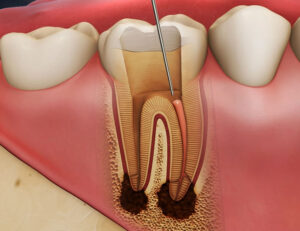 秋葉原の歯医者、スマイルデザインデンタルクリニック秋葉原で、「ボロボロの虫歯」を放置するとどうなる？命に関わるリスクについて解説