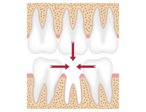 秋葉原の歯医者、スマイルデザインデンタルクリニック秋葉原で、「ボロボロの虫歯」を放置するとどうなる？命に関わるリスクについて解説