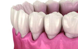 秋葉原の歯医者、スマイルデザインデンタルクリニック秋葉原で、歯が長く見えるのはなぜ？進行を防ぐための治療とケア方法を解説