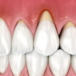 秋葉原の歯医者、スマイルデザインデンタルクリニック秋葉原で、歯が長く見えるのはなぜ？進行を防ぐための治療とケア方法を解説