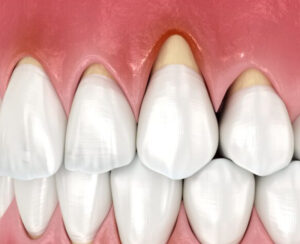 秋葉原の歯医者、スマイルデザインデンタルクリニック秋葉原で、歯が長く見えるのはなぜ？進行を防ぐための治療とケア方法を解説