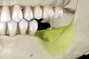 秋葉原の歯医者、スマイルデザインデンタルクリニック秋葉原で、歯が抜けたままは危険！「たった1本の歯の欠損」が招くお口全体の崩壊について解説