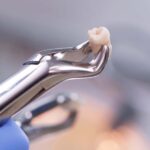 秋葉原の歯医者、スマイルデザインデンタルクリニック秋葉原で、歯が抜けたままは危険！「たった1本の歯の欠損」が招くお口全体の崩壊について解説