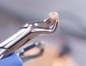 秋葉原の歯医者、スマイルデザインデンタルクリニック秋葉原で、歯が抜けたままは危険！「たった1本の歯の欠損」が招くお口全体の崩壊について解説