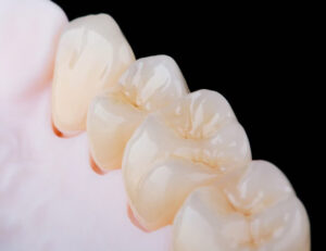 秋葉原の歯医者、スマイルデザインデンタルクリニック秋葉原で、「詰め物が欠けただけ」が命取り？欠けたCR（レジン）を放置するリスクについて解説