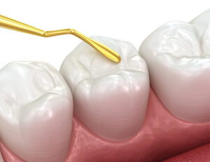 秋葉原の歯医者、スマイルデザインデンタルクリニック秋葉原で、「詰め物が欠けただけ」が命取り？欠けたCR（レジン）を放置するリスクについて解説