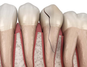 秋葉原の歯医者、スマイルデザインデンタルクリニック秋葉原で、「詰め物が欠けただけ」が命取り？欠けたCR（レジン）を放置するリスクについて解説