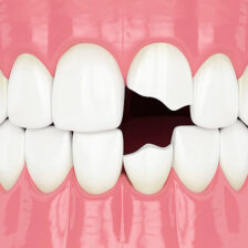 秋葉原の歯医者、スマイルデザインデンタルクリニック秋葉原で、「詰め物が欠けただけ」が命取り？欠けたCR（レジン）を放置するリスクについて解説