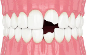 秋葉原の歯医者、スマイルデザインデンタルクリニック秋葉原で、「詰め物が欠けただけ」が命取り？欠けたCR（レジン）を放置するリスクについて解説