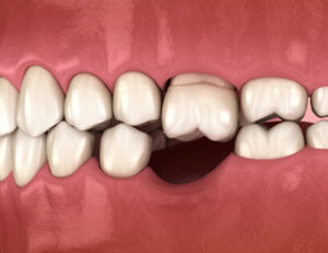 秋葉原の歯医者、スマイルデザインデンタルクリニック秋葉原で、歯が抜けたままは危険！「たった1本の歯の欠損」が招くお口全体の崩壊について解説