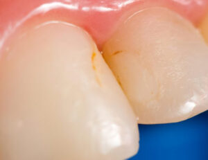 秋葉原の歯医者、スマイルデザインデンタルクリニック秋葉原で、「詰め物が欠けただけ」が命取り？欠けたCR（レジン）を放置するリスクについて解説