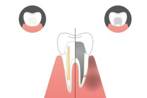 秋葉原の歯医者、スマイルデザインデンタルクリニック秋葉原で、銀歯の下が黒いのは何故？むし歯？治療が必要なサインと見極め方