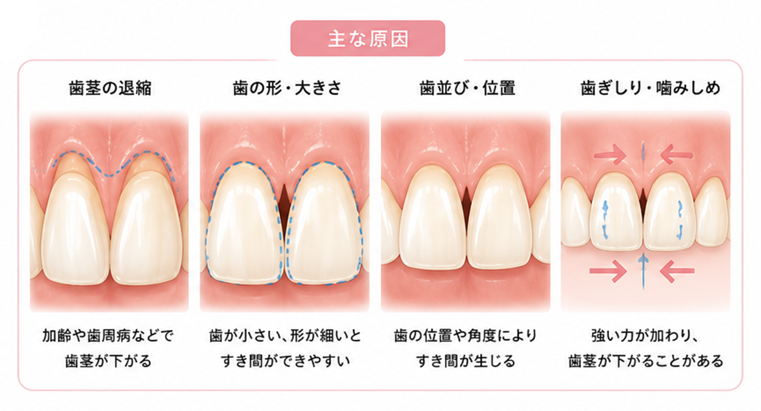 秋葉原の歯医者、スマイルデザインデンタルクリニック秋葉原で、歯茎のすき間「ブラックトライアングル」の原因と、すき間を広げないためのセルフケアについて解説