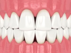 秋葉原の歯医者、スマイルデザインデンタルクリニック秋葉原で、歯茎のすき間「ブラックトライアングル」の原因と、すき間を広げないためのセルフケアについて解説